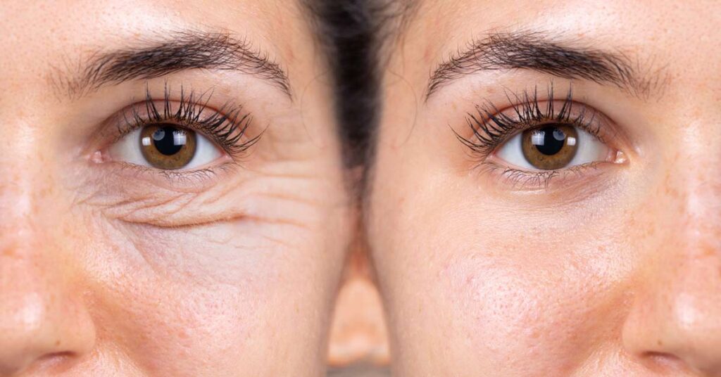 Procedimento de Blefaroplastia: Etapas e cuidados necessários